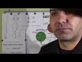 Болезни Мочеиспускательного канала как у Мужчин так и у Женщин Помощь точками Акупунктуры