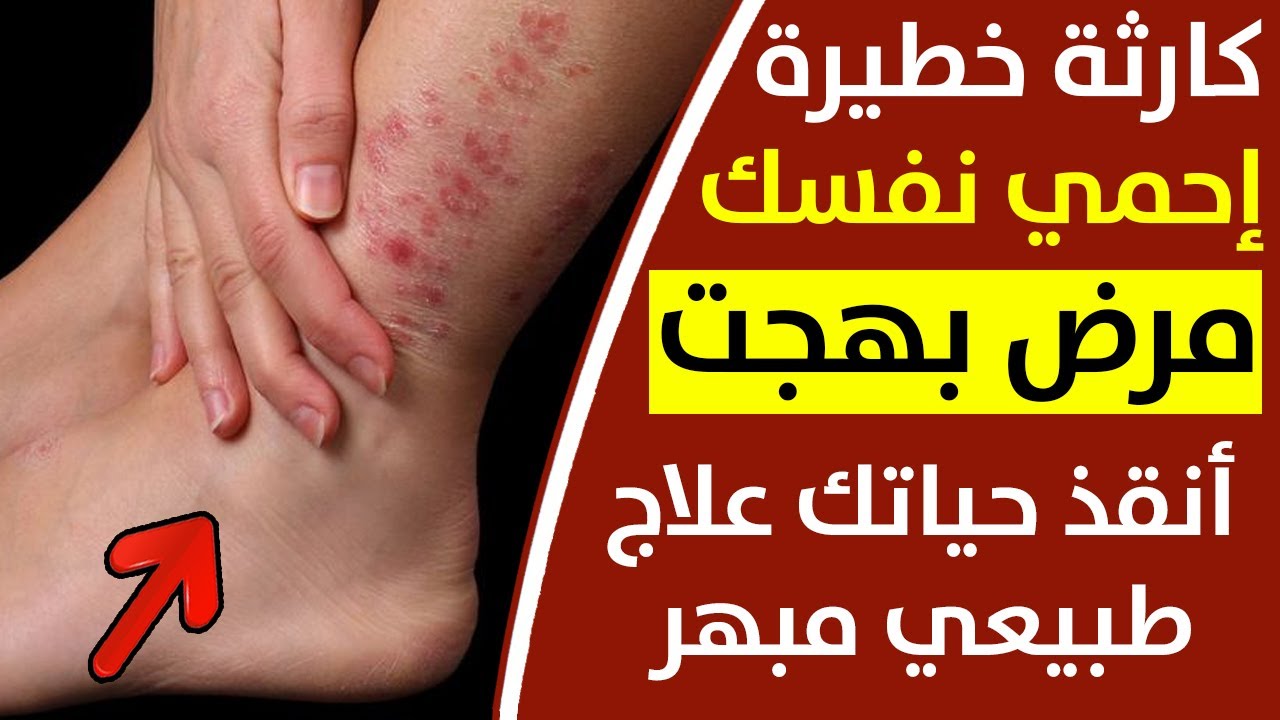 علاج مرض بهجت بأفضل الطرق من خلال وصفة سهلة وبسيطة جدآ|مرض مناعي خطير جدا لا تجاهله لانه يسبب الوفاة