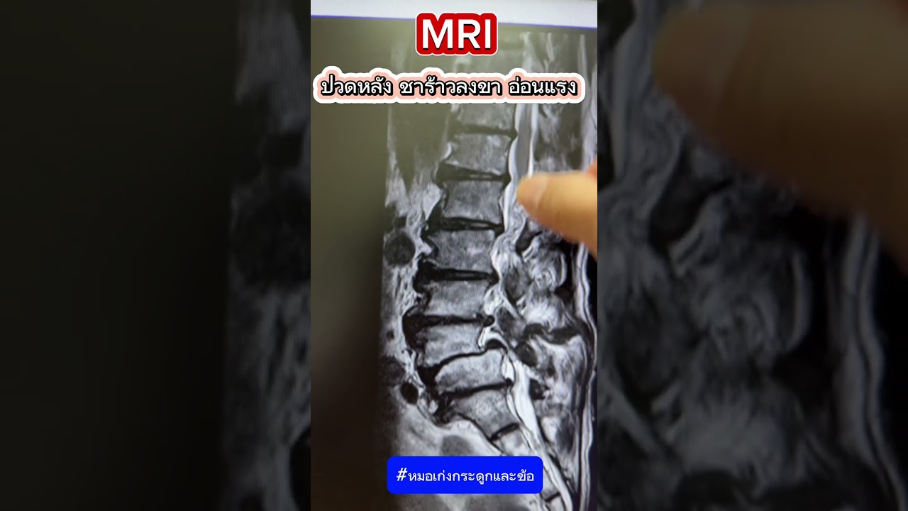 MRI ปวดหลังชาร้าวลงขา อ่อนแรง เป็นอย่างไร? #หมอเก่งกระดูกและข้อ #ปวดหลัง #MRI #หมอนรองกระดูก