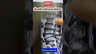 MRI ปวดหลังชาร้าวลงขา อ่อนแรง เป็นอย่างไร? #หมอเก่งกระดูกและข้อ #ปวดหลัง #MRI #หมอนรองกระดูก