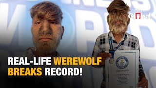 Indian Teen With "Werewolf Syndrome" Sets Guinness World Record for Hairiest Face!