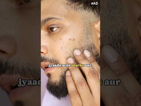 Remove pimple in 3 Days with Novology Acne Spot Corrector|#AD #shorts #youtubeshorts #skincare