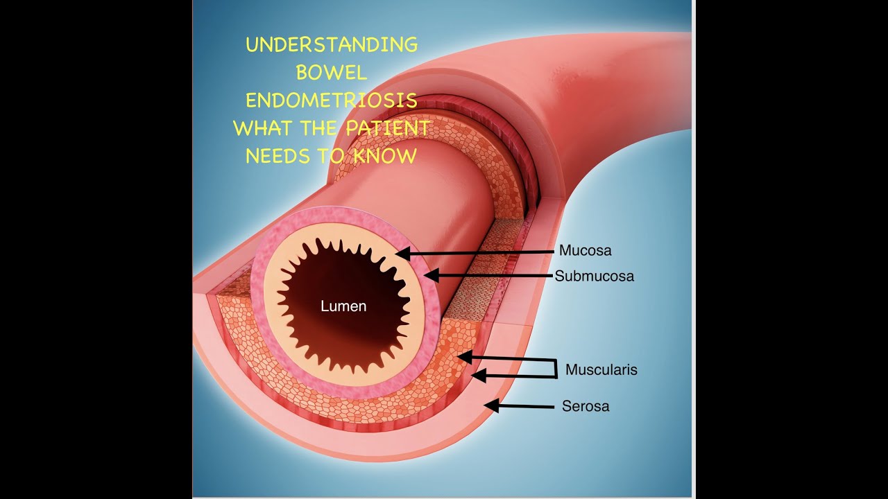 Understanding Bowel endometriosis What patients need to know YouTube