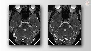 Vascular Loop at the Axilla of the Nerve in Trigeminal Neuralgia (Preview)