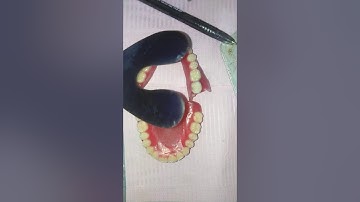 Visit 4: Checking centric occlusion in Try-in