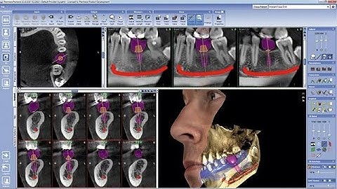 #Dental_Implant module and nerve tracing Using #Romexis #CBCT Viewer Step by step (Dr.Sally Mansour)