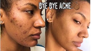 Why I Stopped Using Black Soap | Acne Tips | How I Beat Cystic Acne | Pgeeeeee