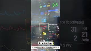 Pulse Pressure Variation | #shorts #ivcannulation #anesthesiology #nurse by ABCs of Anaesthesia 2,348 views 8 days ago 2 minutes, 4 seconds