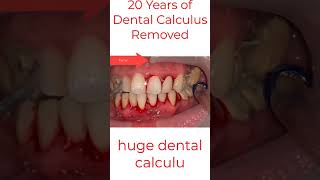 Dental Tartar Dentist New #shorts #2022 screenshot 5