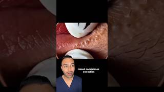 Your lip balm might be causing this Blackheads removal | Dr Somji reacts