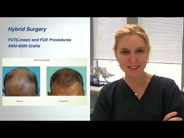 What is Hybrid Hair Transplant? Maximizing Graft Harvest in One Session