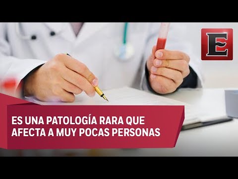 Video: ¿La mielofibrosis afecta los ojos?