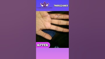 Post traumatic contracture release with Z plasty