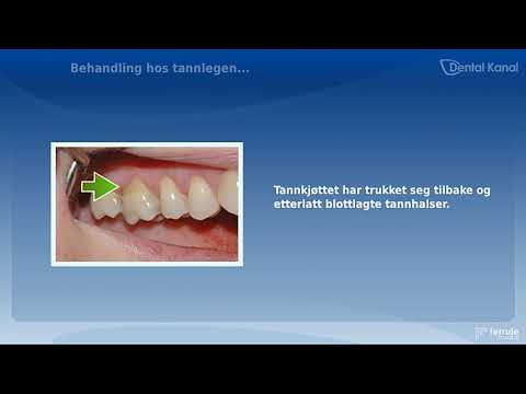 Video: Hvorfor Skader Tannkjøttet Mitt? Årsaker Og Behandling For Tannkjøttsmerter