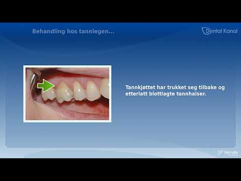 Video: Fibroma I Munnhulen - årsaker Og Symptomer På Fibroma I Tungen Og Fibroma I Tannkjøttet