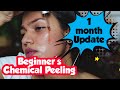 BEGINNERS Chemical Peeling ||One month update||