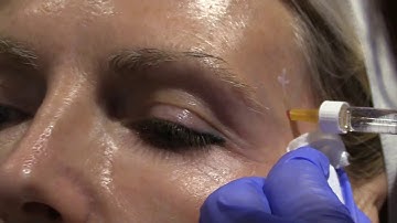 Temporal Hollow Injection