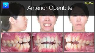 Solving anterior open bite with Damon｜【Chris Chang Ortho】CC707