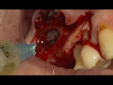 Implantation on maxillary sinus with chronic sinusitis (Live)