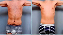 Male Tummy Tuck - Case Study | Dr. Sterry