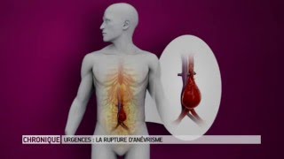 La rupture d'anévrisme : une urgence absolue  Le Magazine de la santé