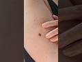 What does melanoma look like? ABCDE warning signs explained