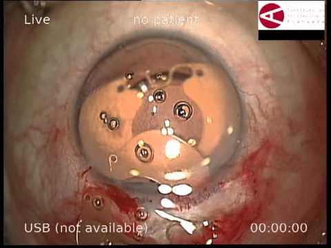 Video: ¿La midriasis traumática es permanente?