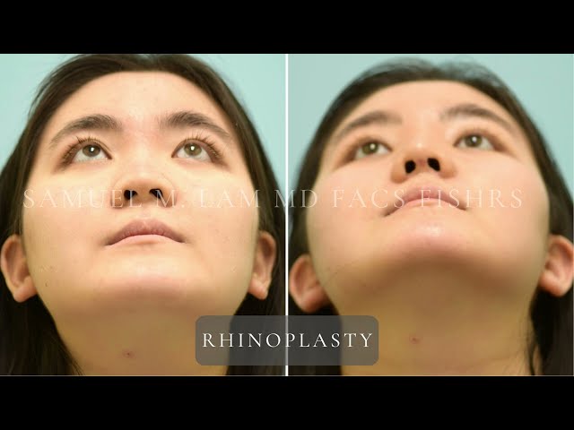 Dallas Cosmetic Surgery | Rhinoplasty | Patient Testimonial