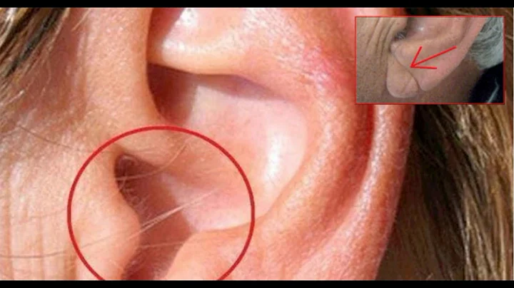 EAR HAIR MAY PREDICT WHETHER YOU WILL DEVELOP HEART DISEASE