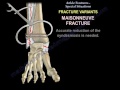 Ankle Fractures , Special Situations - Everything You Need To Know - Dr. Nabil Ebraheim