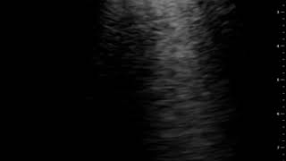 COVID Positive Pleura | Clinical Image