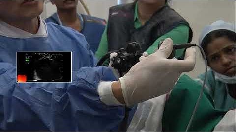 Endo-Master Class 2017: "Hot" AXIOS drainage of pseudocyst