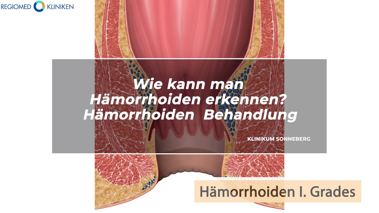REGIOMED Kliniken: Wie kann man Hämorrhoiden erkennen? Hämorrhoiden Behandlung - YouTube