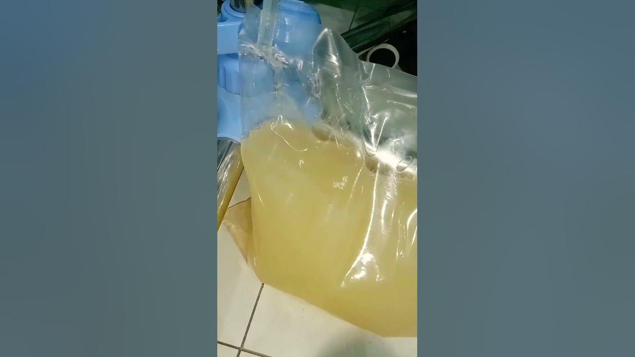 turbid peritoneal fluid peritonitis trending shorts YouTube