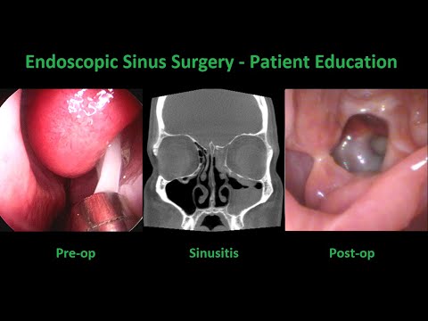 Endoscopic Sinus Surgery, Minimally Invasive  - Dr. Anh Truong - Bellevue Ears, Nose, & Throat (ENT)