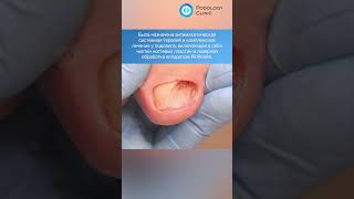 Грибок ногтей #shorts #short #shortvideo #грибокногтей #дерматология #подология #подологмосква
