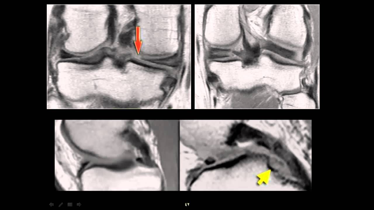 MRI imaging of knee part 1 by Dr. Amr Saadawy YouTube