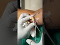 Lipoma Removal Surgery Delhi Painless Scarless Surgery Shorts Lipoma Removal Surgery Delhi Painless Scarless Surgery Shorts