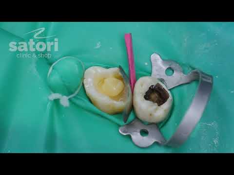 Восстановление зуба фотополимерной пломбой | стоматология Самара влог