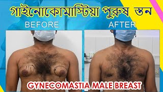 Gynecomastia (Male Breast) Surgery in Kolkata II Man Boobs Surgery in Kolkata | Dr Nagwani