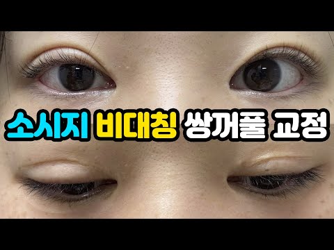 성형상담소 💌 I  소시지 비대칭 쌍꺼풀이 고민이에요