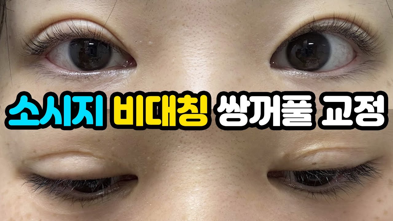 [Ганнам Соён гоо сайхны мэс заслын эмнэлэг] Гоо сайхны зөвлөгөө 💌 | Сосиска шиг, тэгш бус давхрагатай зовхи минь санаа зовоож байна.