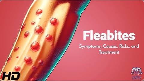 Flea Bite SOS: Immediate Actions for Relief and Recovery