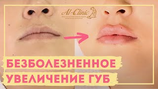 💉 КАК ПРАВИЛЬНО УВЕЛИЧИТЬ ГУБЫ? | Губки бантиком ДО и ПОСЛЕ | Увеличение Губ Гиалуроновой Кислотой