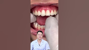Duy trì hàm răng sau khi tháo niềng |Dr Cường Official