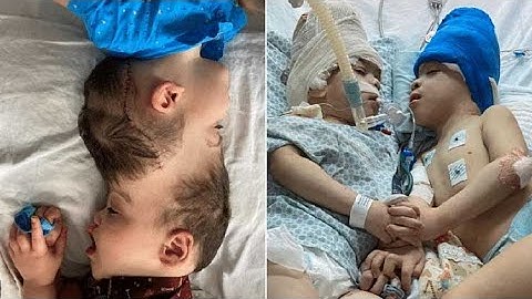 Conjoined twins separated with the help of virtual reality