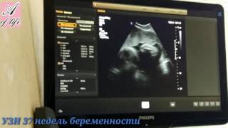 УЗИ 37 недель беременности. Возможно ли родить самой малыша с лейомиомой УЗИ 37 недель беременности. Возможно ли родить самой малыша с лейомиомой