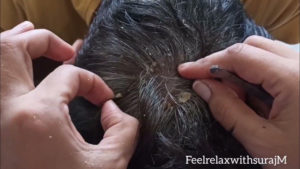 Scratching Dandruff YouTube