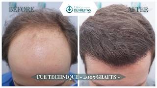 Hair Graft Technique FUE - 4.005 Grafts (10.413 Hairs) - Dr. Rafael de Freitas