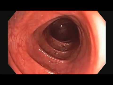 ColonoscopiesColonoscopiesare important in detecting and preventing colorectal cancer, the second le. ColonoscopiesColonoscopiesare important in detecting and preventing colorectal cancer, the second le.